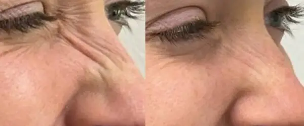 Before and after example of bunny line Botox treatment results
