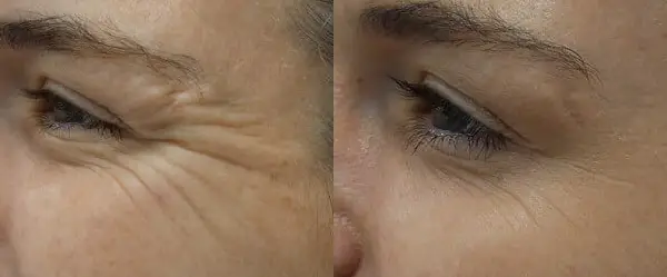 Before and after example of crow’s feet Botox treatment results