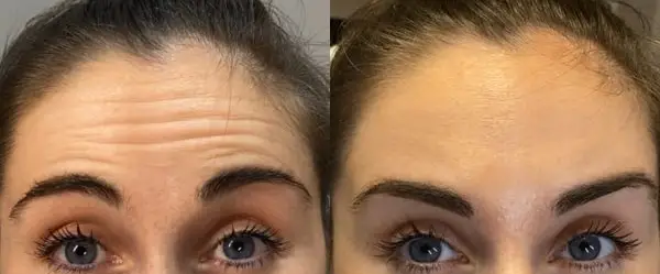 Before and after example of forehead Botox treatment results