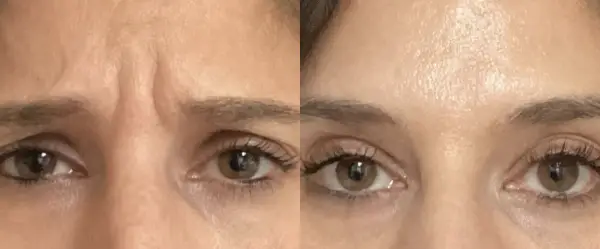 Before and after example of frown line Botox treatment results